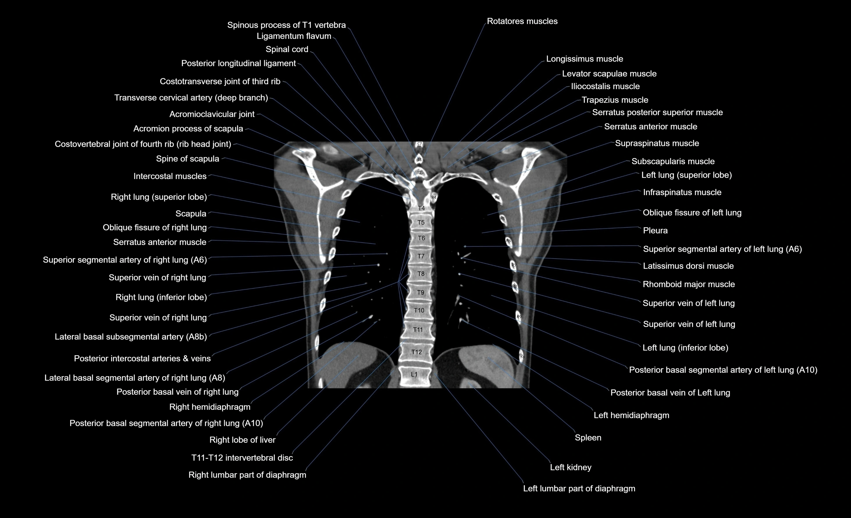 CT chest (thorax) labelled coronal cross sectional anatomy radiology image-00035.webp